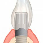 Импланты Nobel Biocare- уникальная стоматология из Швейцарии