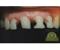 До и после протезирования зубов металлокерамикой