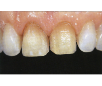 Эстетическая стоматология - фото до и после