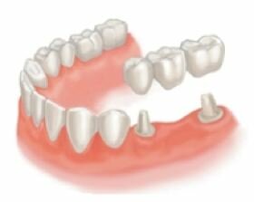 Типы протезирования зубов